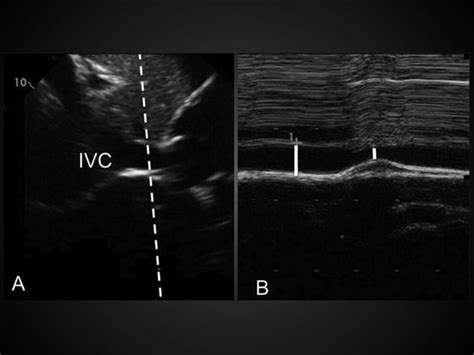 Focused Cardiac Ultrasound Ppt