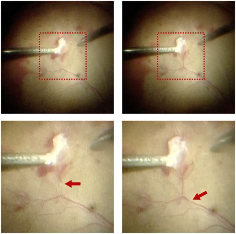 Frontiers Case Reports Intraoperative Migratory Retinal Venous