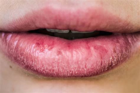 Swollen Lip Causes, Why Is My Lip Swollen – Allergies, Trauma, Sores