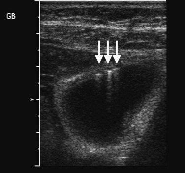 Ultrasound of the liver, biliary tract, and pancreas | Clinical Gate ...