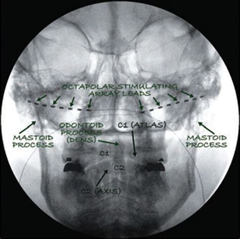 Occipital Nerve Distribution