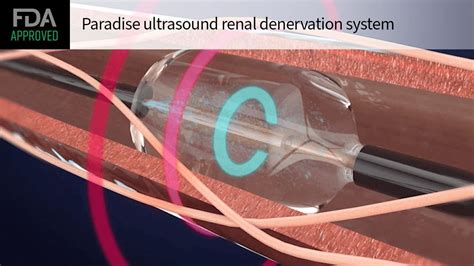 A New Horizon In Hypertension Treatment FDA Approves Innovative Renal