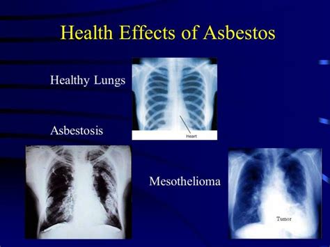 Asbestos Lung Cancer Vs Mesothelioma