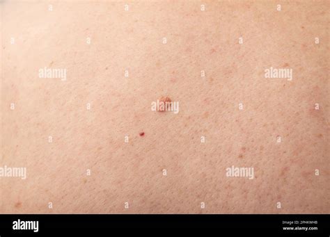 Skin Mole Closeup Macro Photo Of Blemish Similar To Melanoma Brown