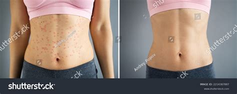 Psoriasis Disease Treatment Before After Dermatology Stock Photo ...