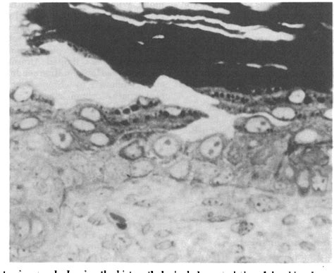 Figure 1 From Staphylococcal Scalded Skin Syndrome 322 Experimental