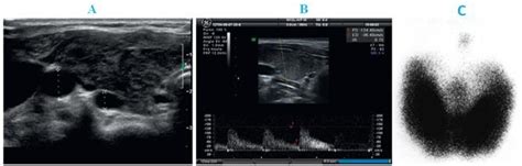 Graves Disease A Grayscale Ultrasound Homogeneous Hypoechoic