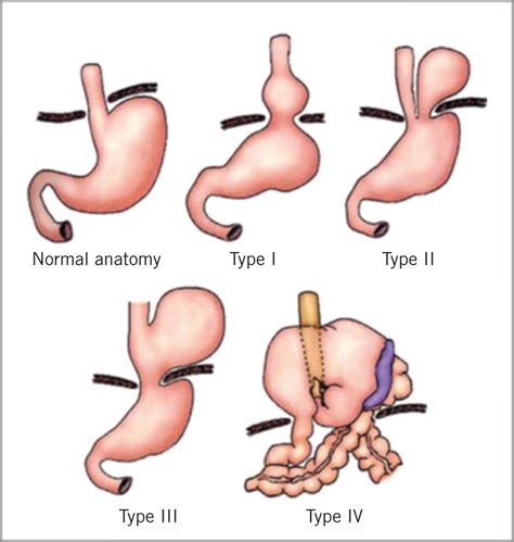 Types Of Hiatal Hernia Surgery