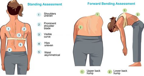 Scoliosis Check How To Conduct A Basic Scoliosis Check At Home And