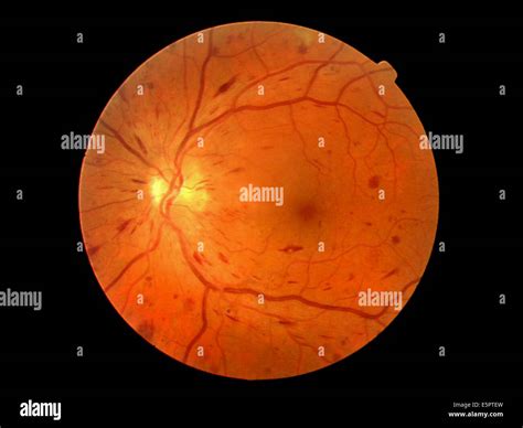 Retinopatía diabética proliferativa fotografías e imágenes de alta