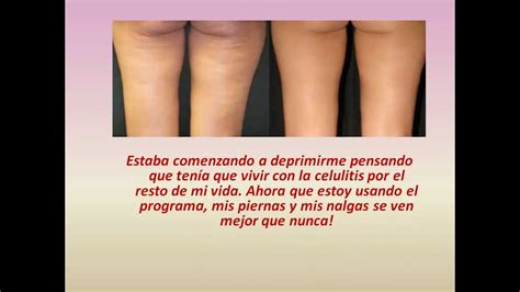 Como Eliminar La Celulitis De Manera Definitiva Gluteos Y Piernas Youtube