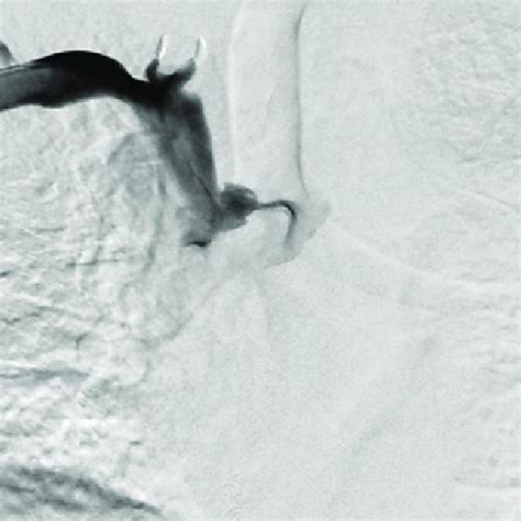 Superior Vena Cavogram Demonstrating Complete Occlusion Of The Superior Download Scientific