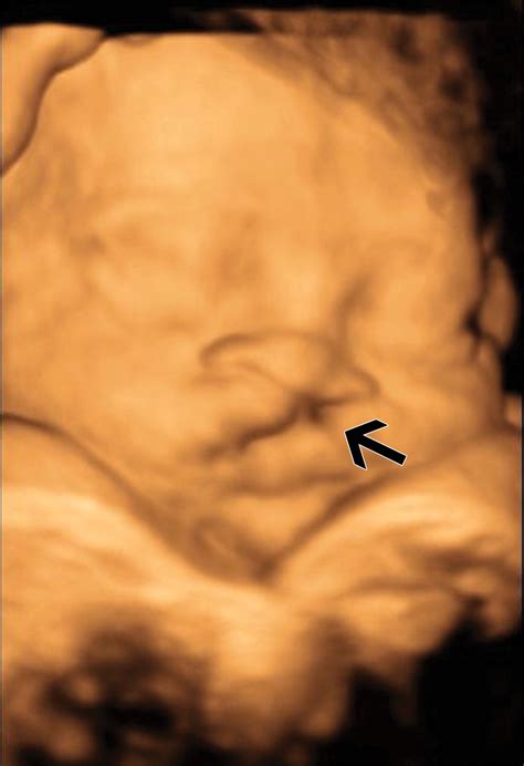 Congenital Oral Masses An Anatomic Approach To Diagnosis Radiographics