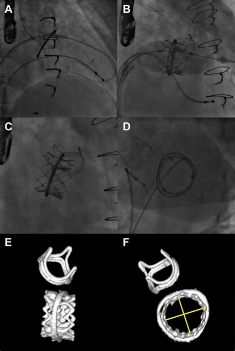 Transfemoral Implantation Of Transcatheter Heart Valves After