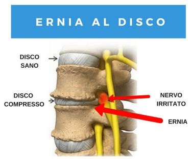 L Ozono Terapia Efficace Per L Ernia Del Disco Ozonoterapia E