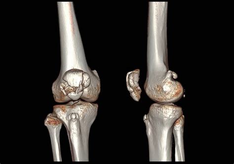 Tomograf A Computarizada De Rodilla Imagen De Representaci N 3D AP Y