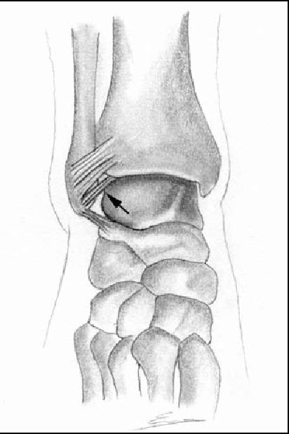 Figure 3 From Mr Imaging Of Ankle Impingement Syndromes Semantic Scholar