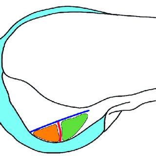 Schematic drawing of the medial wall of the lateral femoral condyle ...