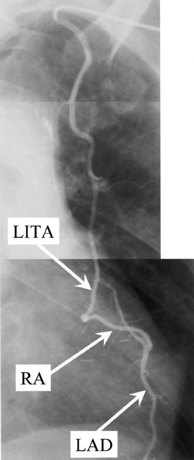 A Postoperative Angiogram Showed A Widely Patent H Graft From The Left