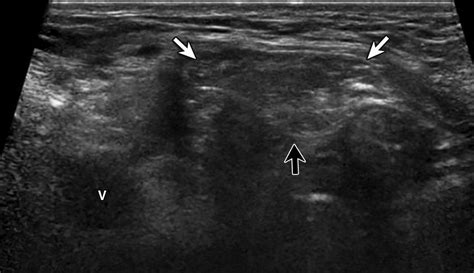 Ultrasound Of The Groin Techniques Pathology And Pitfalls Ajr