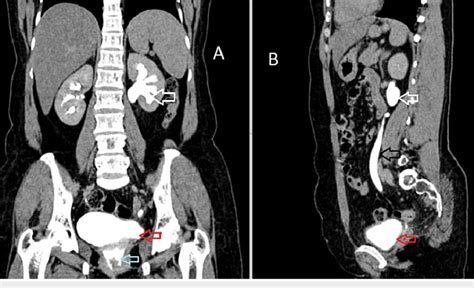 Coronal A And Sagittal B Images Of The Excretory Phase 15 Mins