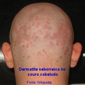 Dermatite Seborreica Sintomas Causas E Tratamento Md Sa De