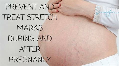 Mommy How To Prevent And Treat Stretch Marks During And After