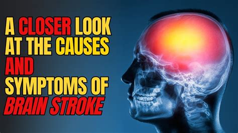 Brain Strokes Causes Symptoms And Recovery What Are Strokes And