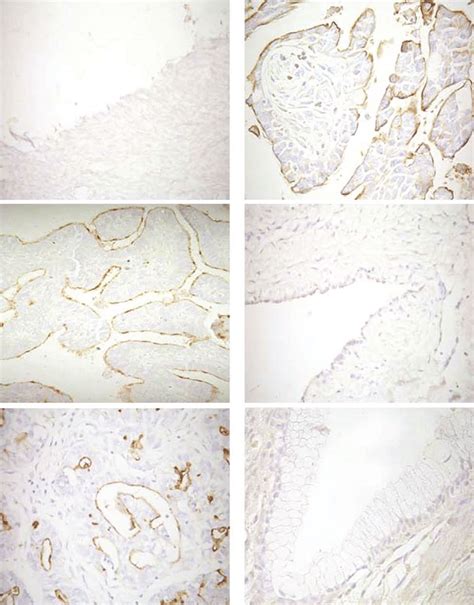 Immunohistochemistry Of Ovarian Tumors And Normal Ovaries Samples With