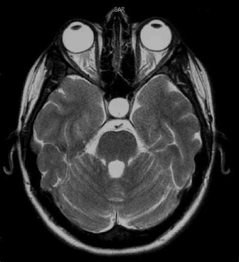 Pseudotumor cerebri | pacs