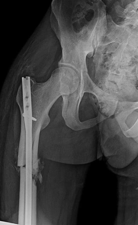 -X-ray showed multi fragmented right femur fracture | Download ...