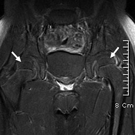 Septic Arthritis Versus Transient Synovitis Of The Hip Gadolinium