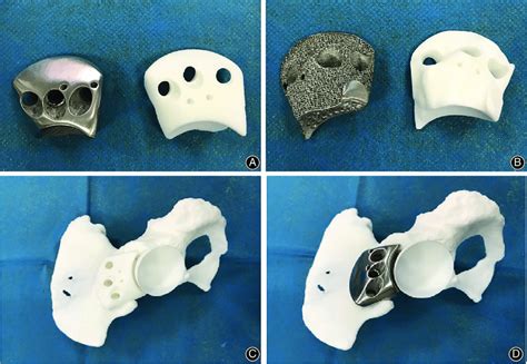 The Material Objects Of D Printed Augment And Pelvis A B The