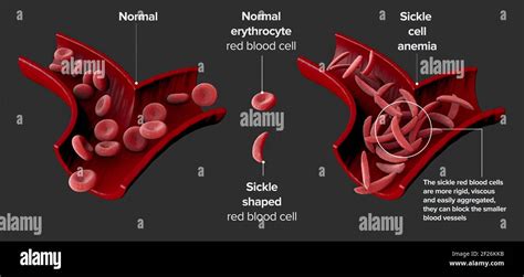 Sickle Cells Fotos Und Bildmaterial In Hoher Aufl Sung Alamy