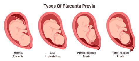 What Are Placenta Previa And Accreta Pregnancy Baby