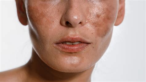 Melasma Why You Get It And How To Say Goodbye To It