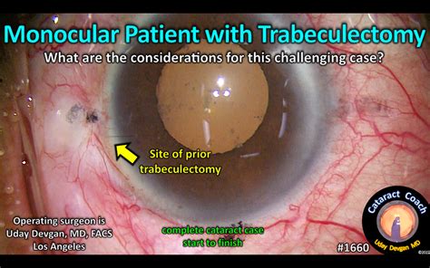 1660 Monocular Patient With Prior Trab Cataract Coach™