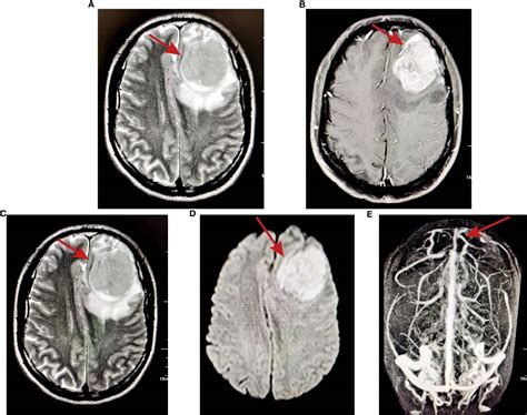 Frontiers Rhabdoid Meningioma With A History Of Budd Chiari Syndrome