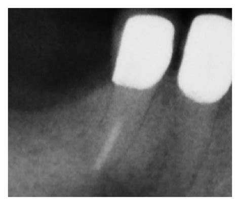 A Periapical Radiograph Prior To Root Canal Treatment B Tracking