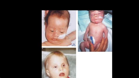 Case 347 Zellweger Syndrome Cerbro Hepato Renal Syndrome Hypotonia