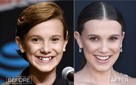 Millie Bobby Brown Plastic Surgery Rumors Expert Opinion Analysis