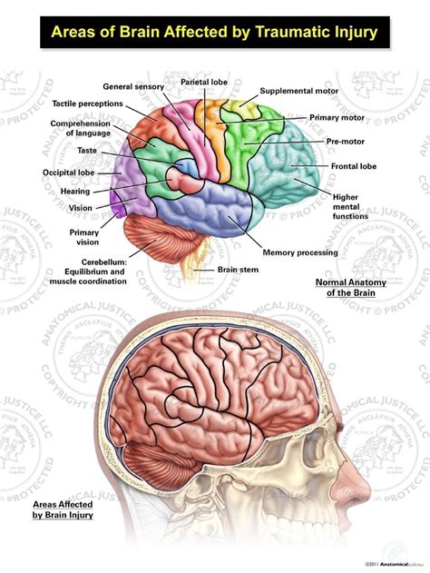 areas   brain affected  traumatic injury  male