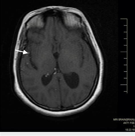 Figure 1 From Magnetic Resonance Imaging Findings In A Rare Case Of A