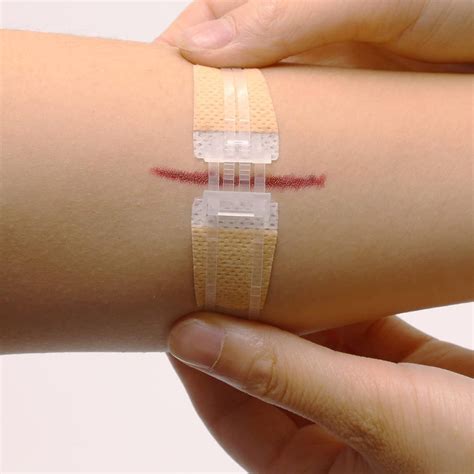 Butterfly Bandages Your Essential Guide To Quick And Effective Wound Care