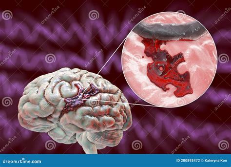 Hemorrhagic Stroke, Illustration Stock Illustration - Illustration of ...