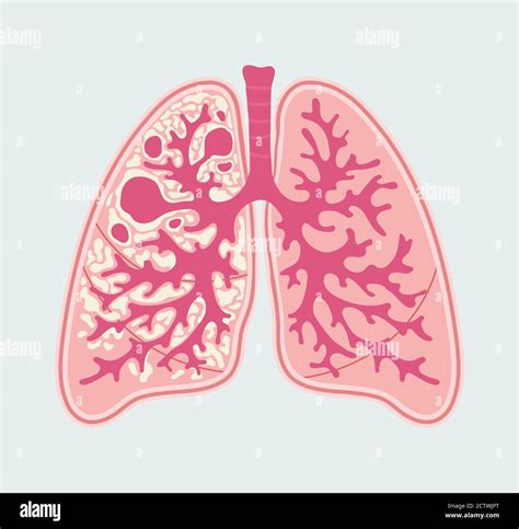 Esquema De Daños A La Tuberculosis En El Pulmón Humano Diagrama