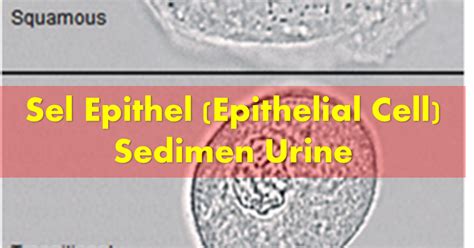 Sel Epithel (Epithelial Cell) Sedimen Urine - Seri Edukasi Teknologi ...