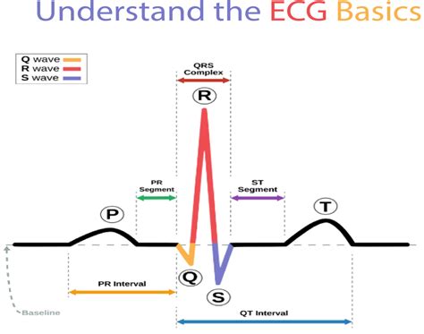 Interpreting St Elevations On An Ecg Electrocardiogram 2024