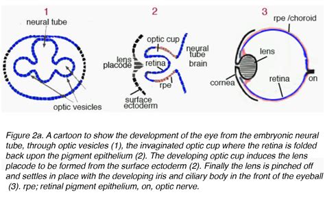 Crystalline Lens and Cataract by Joah F. Aliancy and Nick Mamalis ...