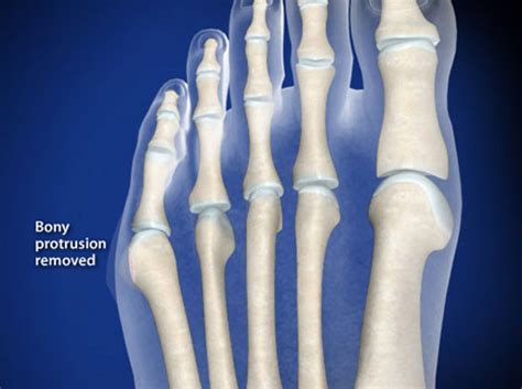 Video - Bunionette Deformity Correction (Fifth Metatarsal Partial Head ...